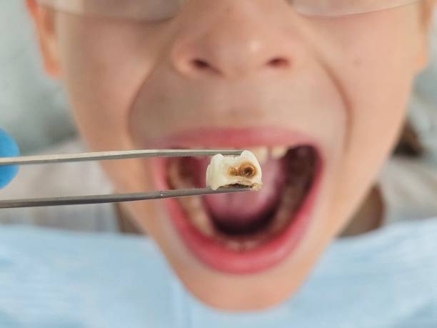 Best Dentist for Tooth Abscess  in Gonzales, LA